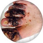 Toes with advanced arterial ulcer with gangrene icon